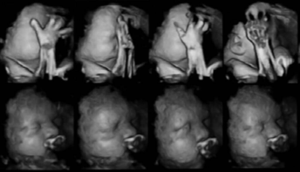 Fetuses of mothers who smoked (top row) moved their mouths and touched their faces more frequently.